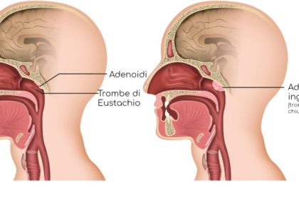 adenoidid