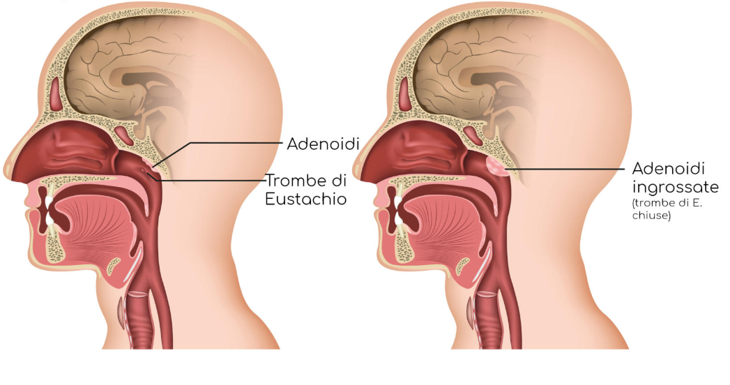 adenoidid